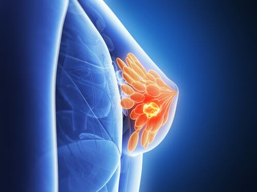 브라 착용이 유방암 발병에 영향을 미칠까?
