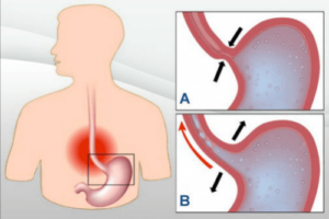위산 역류를 막는 7가지 천연 요법