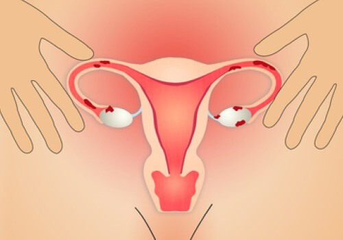 영양섭취로 치료하는 자궁내막증