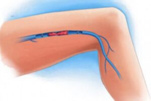 다리 혈전의 증상