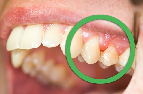 치은염의 천연 치료법