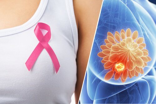유방암의 10가지 징후
