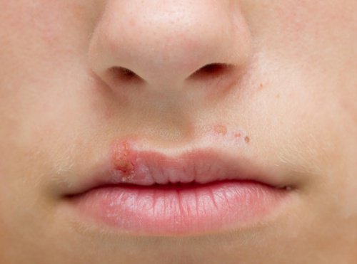 입술 포진 헤르페스 물집 생겼다면 원인은? : 네이버 블로그
