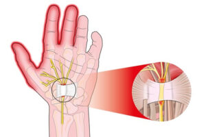 손목 터널 증후군 치료하기