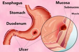위궤양 천연 치료법