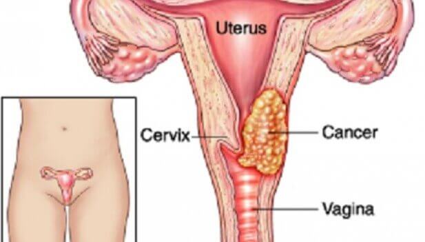자궁 경부암 발병의 7가지 요소