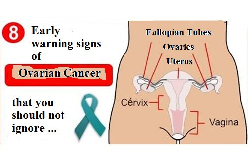 무시해선 안되는 난소암의 초기 징후 8가지