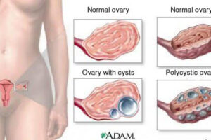 여성이 알아야 할 난소낭종에 대한 9가지 사실