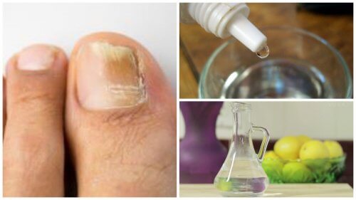 3가지 재료를 이용한 자연적인 손톱 곰팡이균 치료법