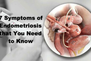 당신이 알아야 하는 자궁내막증의 7가지 증상
