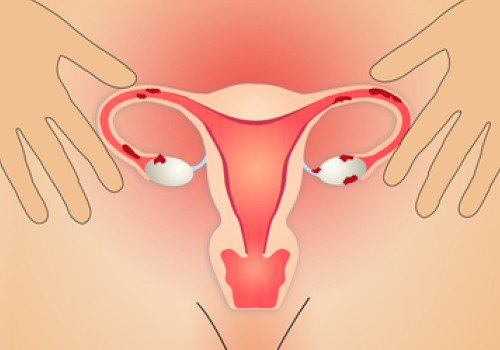생리 중 덩어리혈에 대해 알아야 할 5가지 사실 자궁내막증