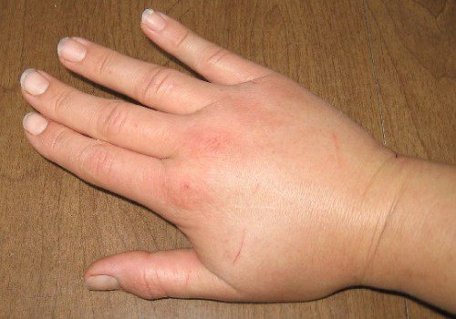 4-swollen-hand