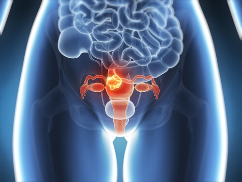 꼭 알아두어야 할 자궁경부암 증상 6가지