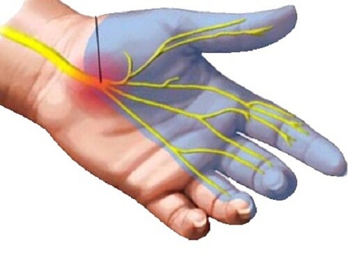 손목 터널 증후군을 완화하기 위한 7가지 방법