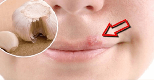 입술 물집을 빨리 치유하는 홈치료제