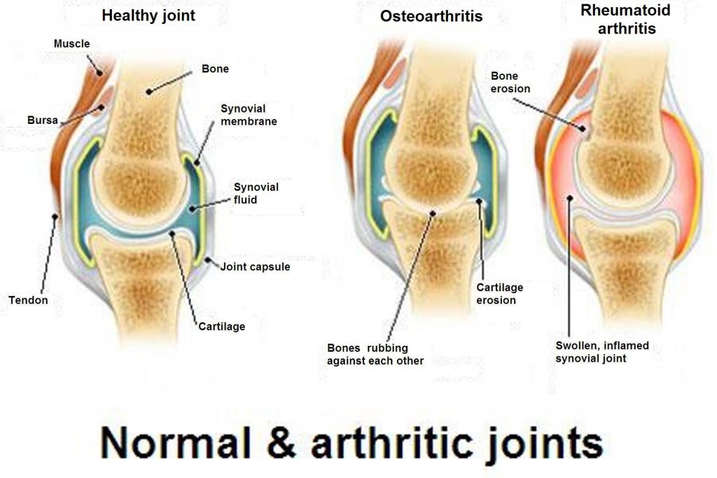 관절염, 골관절염 및 골다골증의 차이점