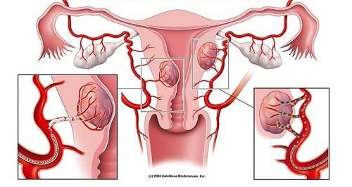 자궁근종에 대한 경고 징후 7가지