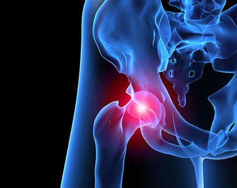 대퇴골 관골구 충격(Femoroacetabular Impingement)