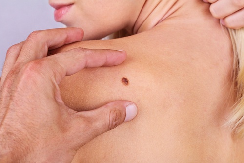 무시해서는 안 되는 6가지 피부암 증상