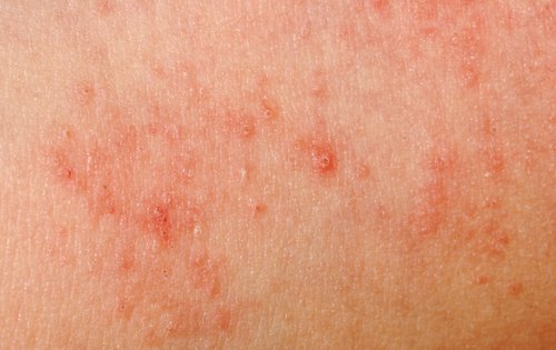 천수국을 활용해 피부 감염을 예방 및 제거할 수 있다