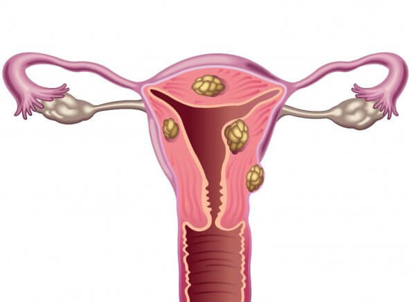 자궁섬유종은 무엇일까: 중요한 사실 5가지