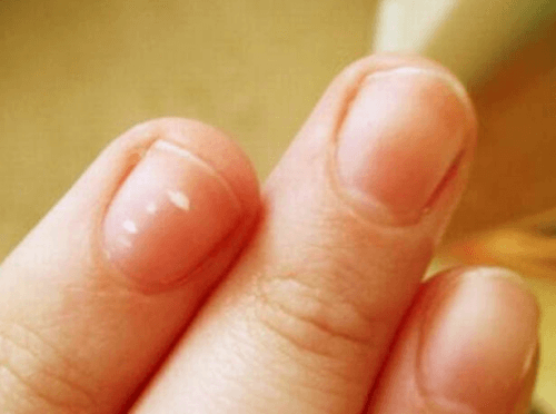 건강한 손톱 모양: 속손톱이 건강에 대해 말하는 것