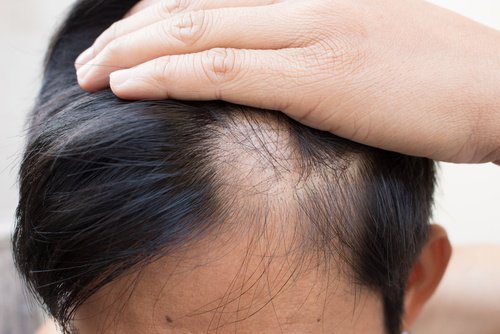 대머리 자연 치료법 6가지