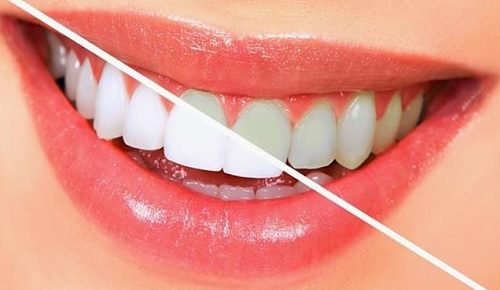 치아를 자연적으로 하얗게 하는 10가지 음식