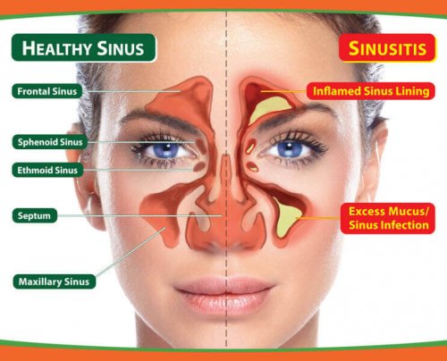 sinusitis 축농증의 원인 증상 기침 비염 두통 전염 감기 축농증에 좋은 음식