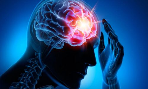 가장 흔한 뇌혈관 질환 4가지