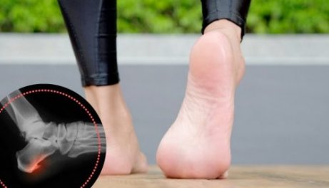 발뒤꿈치 통증 증후군 치료를 위한 운동 5가지