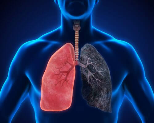 무시하면 안 되는 폐렴 증상 8가지