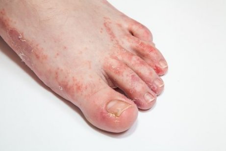 피부 곰팡이균을 퇴치하는 15가지 치료법