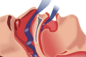수술 없이 수면 무호흡증을 치료할 수 있을까?