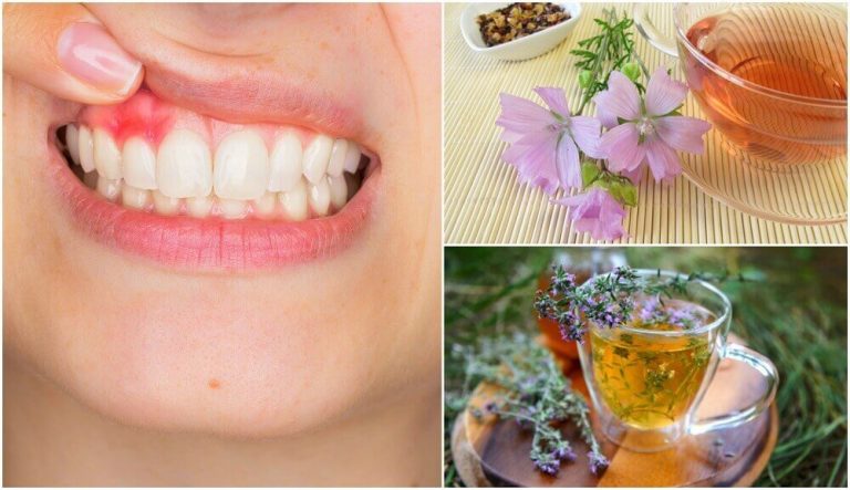 치은염 걱정을 없애는 5가지 자연 치료제