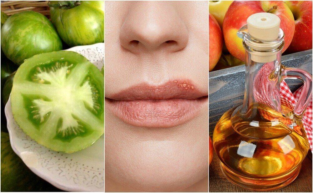 5가지 자연 치유법으로 입술 포진을 치료하자