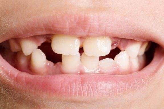 치아 발육부전의 유형과 치료법