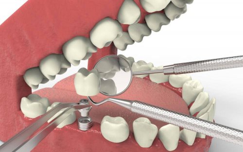 치아 발육지연의 유형과 치료법