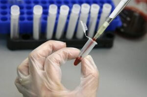 HIV를 근절시키는 줄기세포 이식