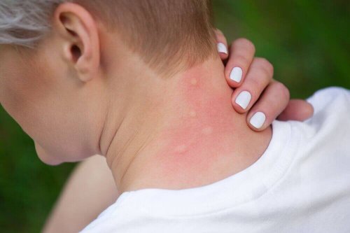 벌레물림 알레르기를 진정시키는 5가지 치료법