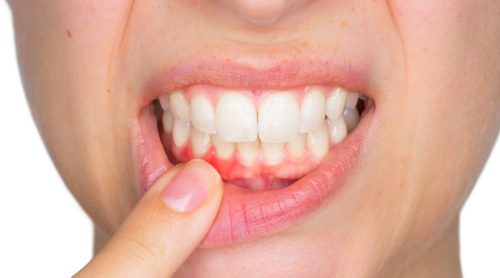 치아 낭종은 무엇일까?