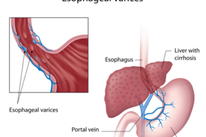 식도정맥류의 징후와 증상
