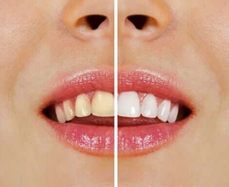 치아 미백을 위한 천연 제품