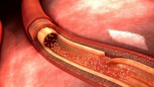 대동맥 박리는 무엇이며 어떻게 치료할까?