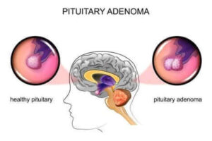 뇌하수체 선종의 원인과 증상