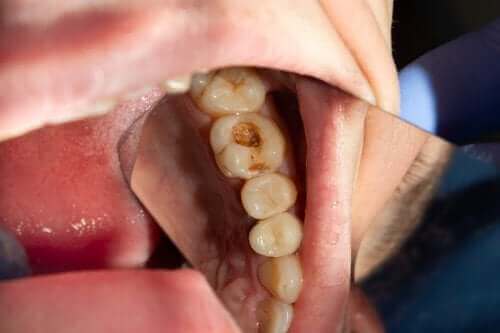 치아우식증: 충치의 원인은 무엇일까?