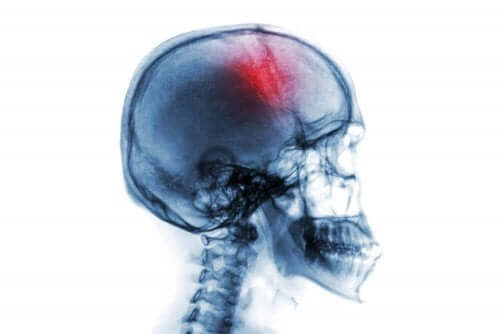 뇌졸중 위험 요인 및 증상 