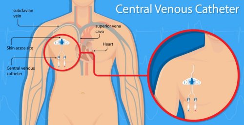 혈관 천공 및 중심 정맥 카테터