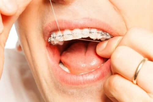 교정 치료 중 치아 위생을 유지하는 비결 7가지
