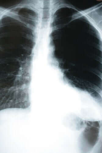 폐렴이 신체에 미치는 영향